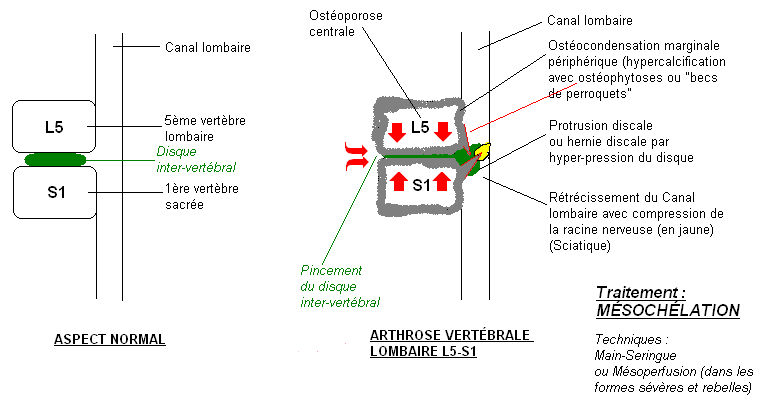 Schémas de l'arthrose lombaire