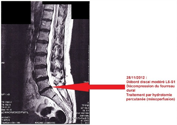 Cas cliniques hernies discales ┃ Société d'hydrotomie percutanée