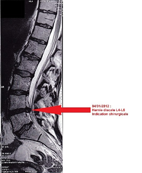 Hernie discale indication chirurgicale