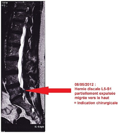 Hernie discale partiellement expulsée