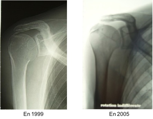 Périarthrite calcifiante de l'épaule