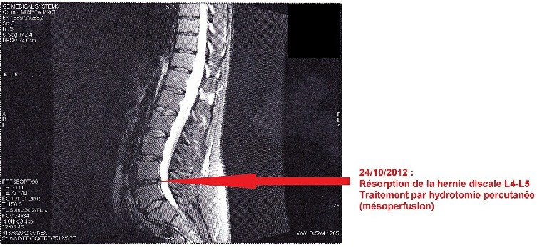 Résorbtion de la hernie discale
