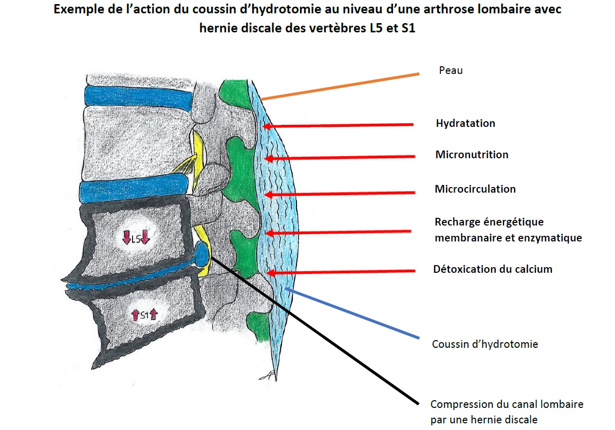 coussin d'hydrotomie arthrose lombaire