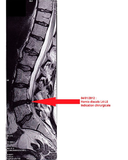 Hernie discale l4 l5