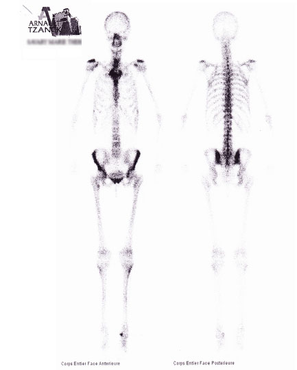 Algodystrophie apres