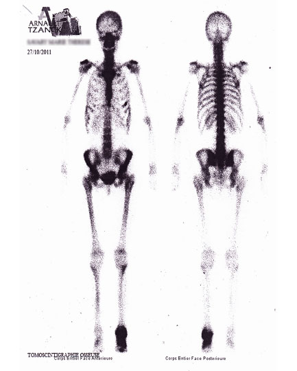 Algodystrophie avant